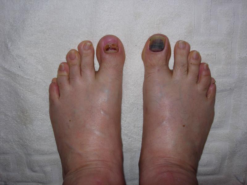 So is my toenail gonna fall off? (pic of purpleness)